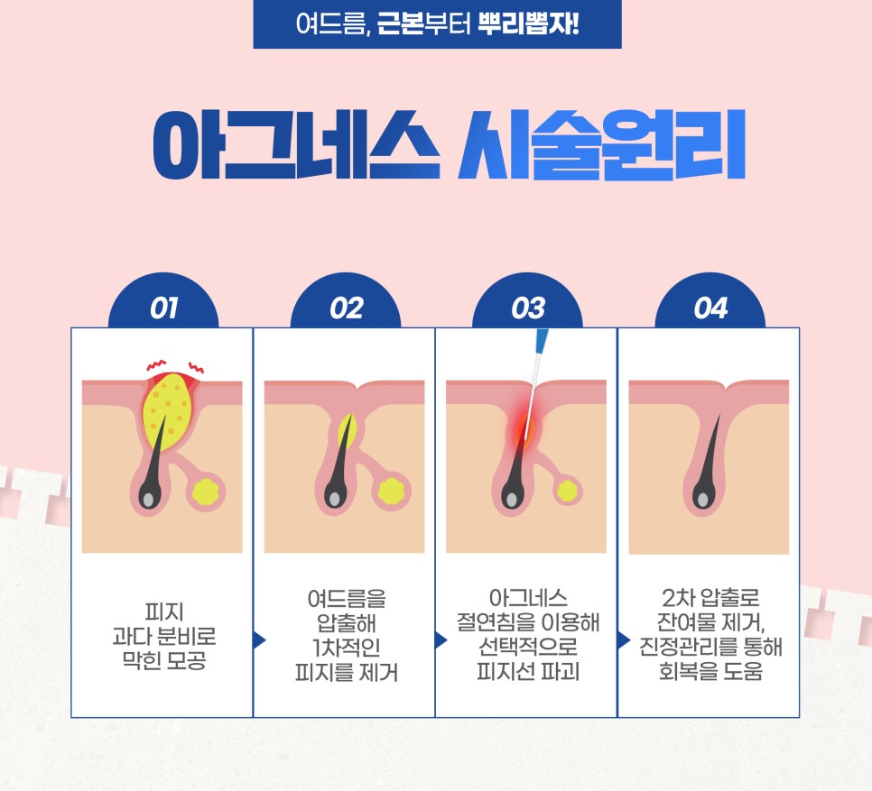 블랙헤드관리, 모공 속 피지 관리가 우선 관련 이미지 7