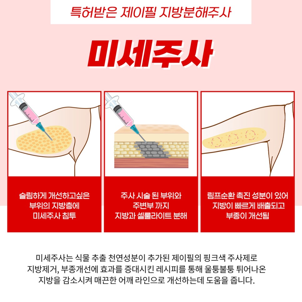 팔뚝, 어깨라인을 한번에 지방흡입한듯 여리하게 만들고싶다면? 관련 이미지 5