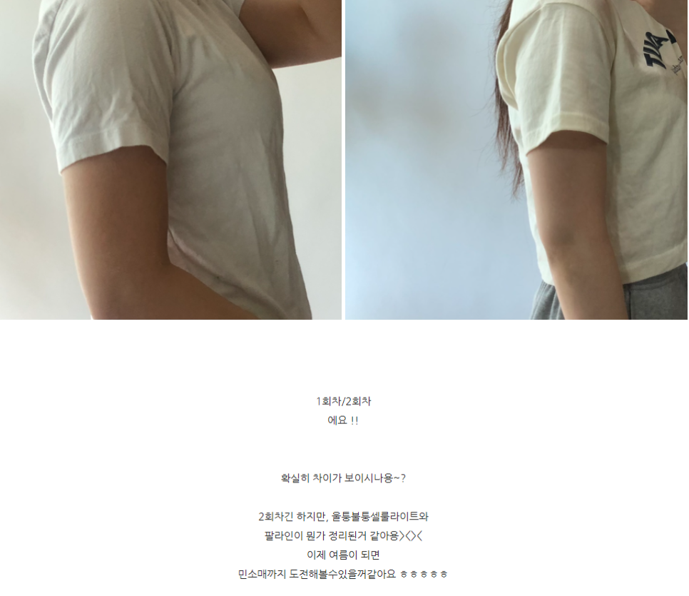 팔뚝지방분해주사 리얼 후기 (no스테로이드) 관련 이미지 1