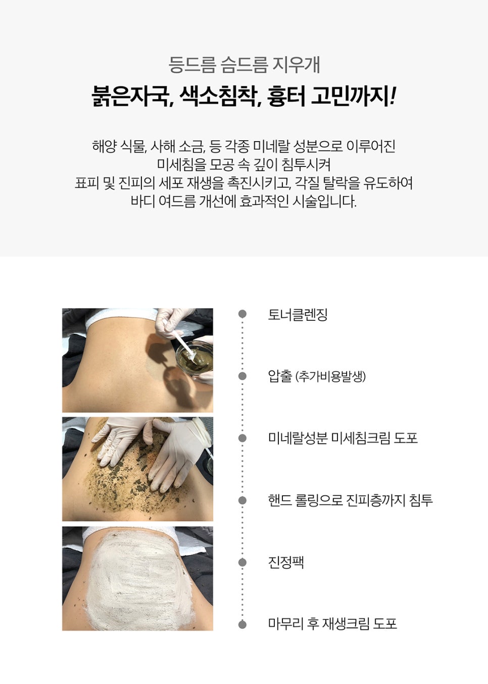 등드름제거는 알리딘필링으로 확실하게! 관련 이미지 4