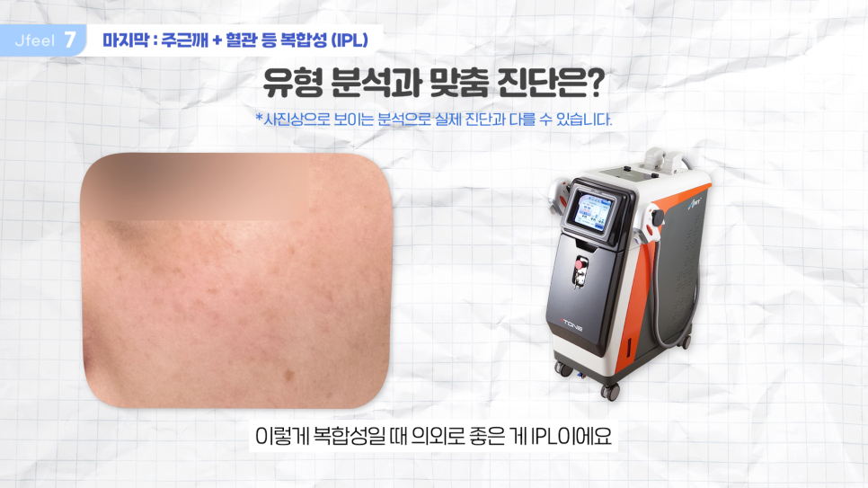 홍대 피부과 기미 잡티제거 레이저 및 구분법 관련 이미지 14