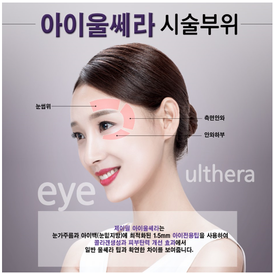 &ldquo;뚜렷한 눈&rdquo; 수술없이 주사로 1분이면 OK 눈두덩이 주사 관련 이미지 5