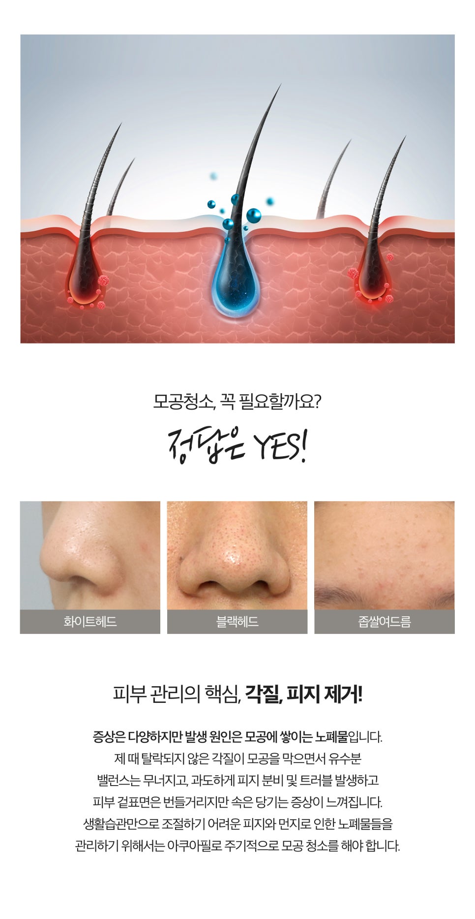 모공청소 블랙헤드제거는 메디컬스킨케어 관련 이미지 2