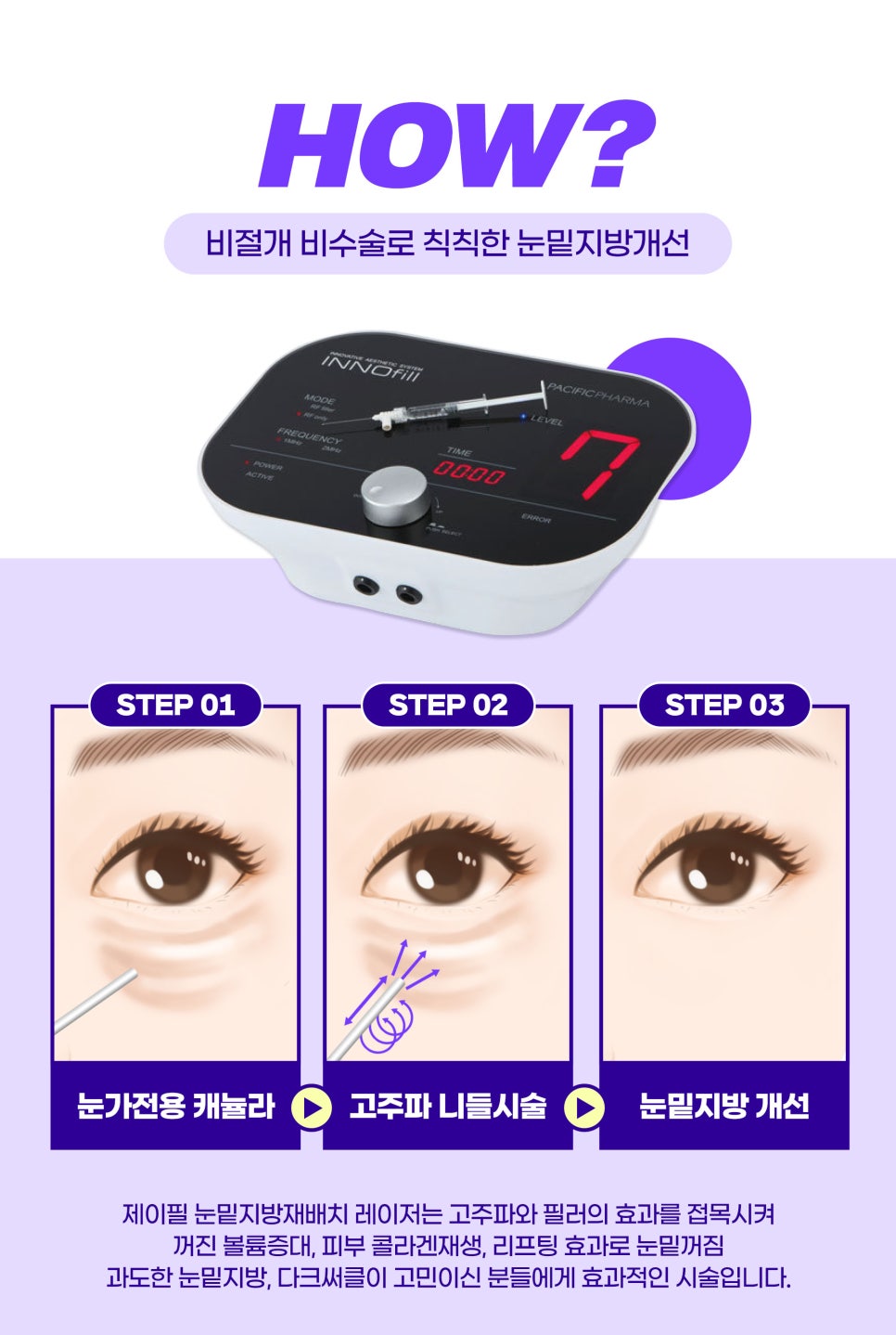 수술없이 눈밑지방재배치 레이저! 가격,효과,후기까지 관련 이미지 2