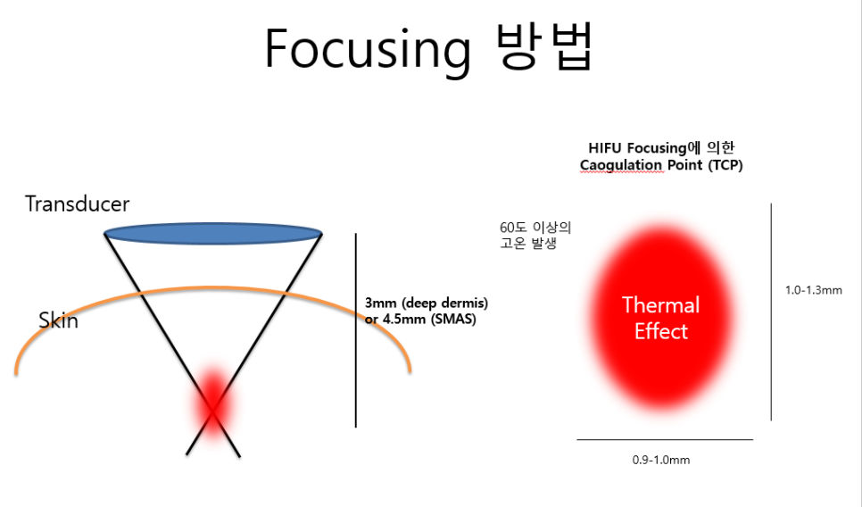 [홍대피부과] 제이필의원의 슈링크 vs. 울쎄라 그 차이에 대한 고찰 관련 이미지 2