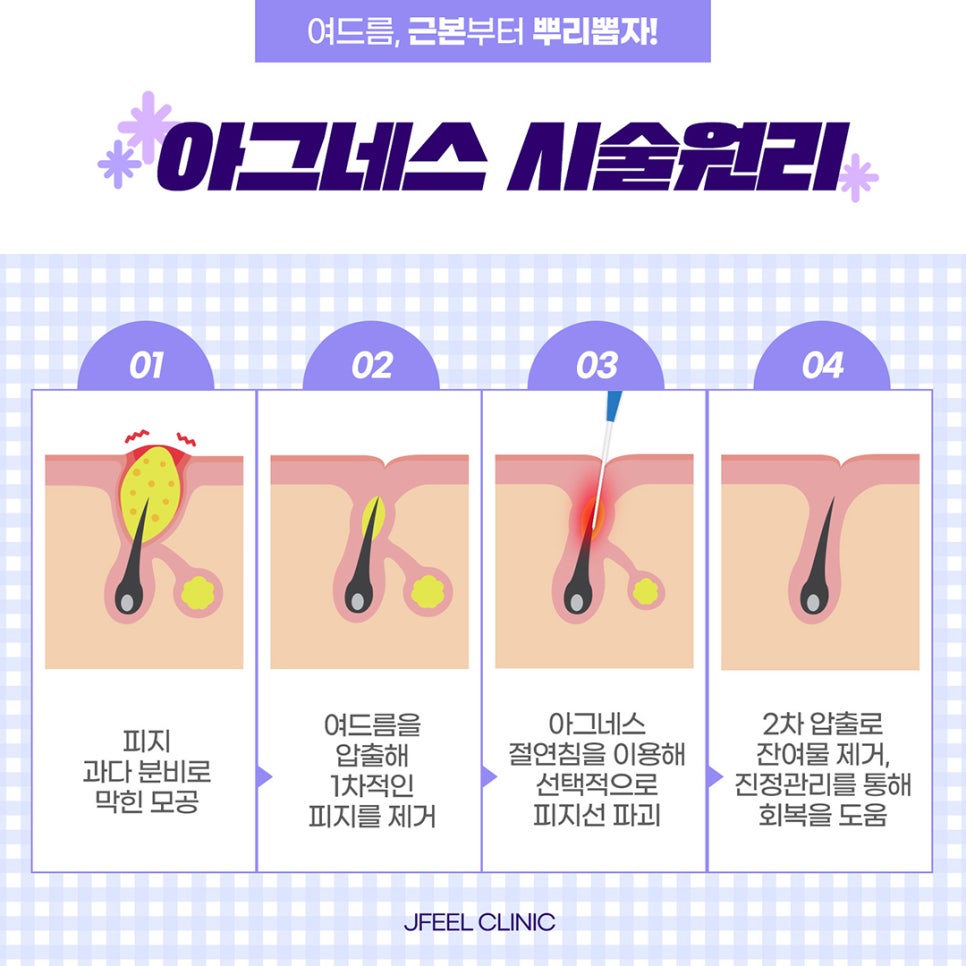 마스크 속 피부 트러블,여드름도 제이필의 마그네스로 케어해보세요 관련 이미지 4