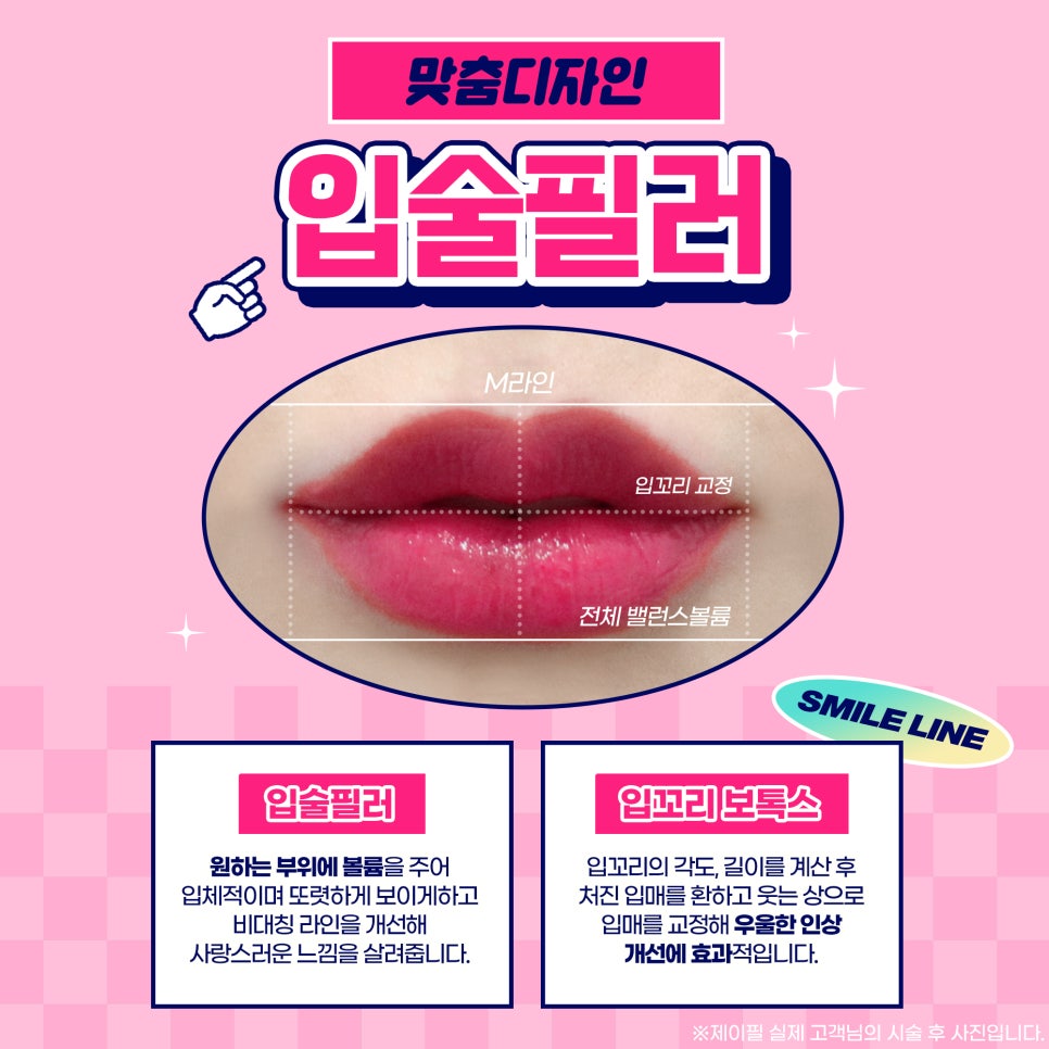 얼굴 동안시술로 자연스럽게 예뻐지고 싶다면? 관련 이미지 4