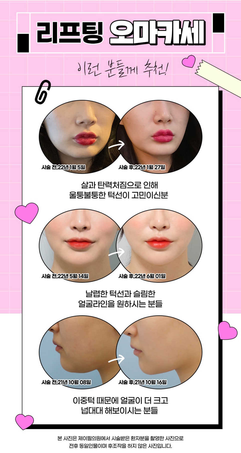 홍대입구역피부과에서 리프팅오마카세로 효과 보기 관련 이미지 6