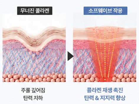 Concerned About a Long Face? The Real Reason Your Philtrum Looks Long—and When Sofwave May Help image 6