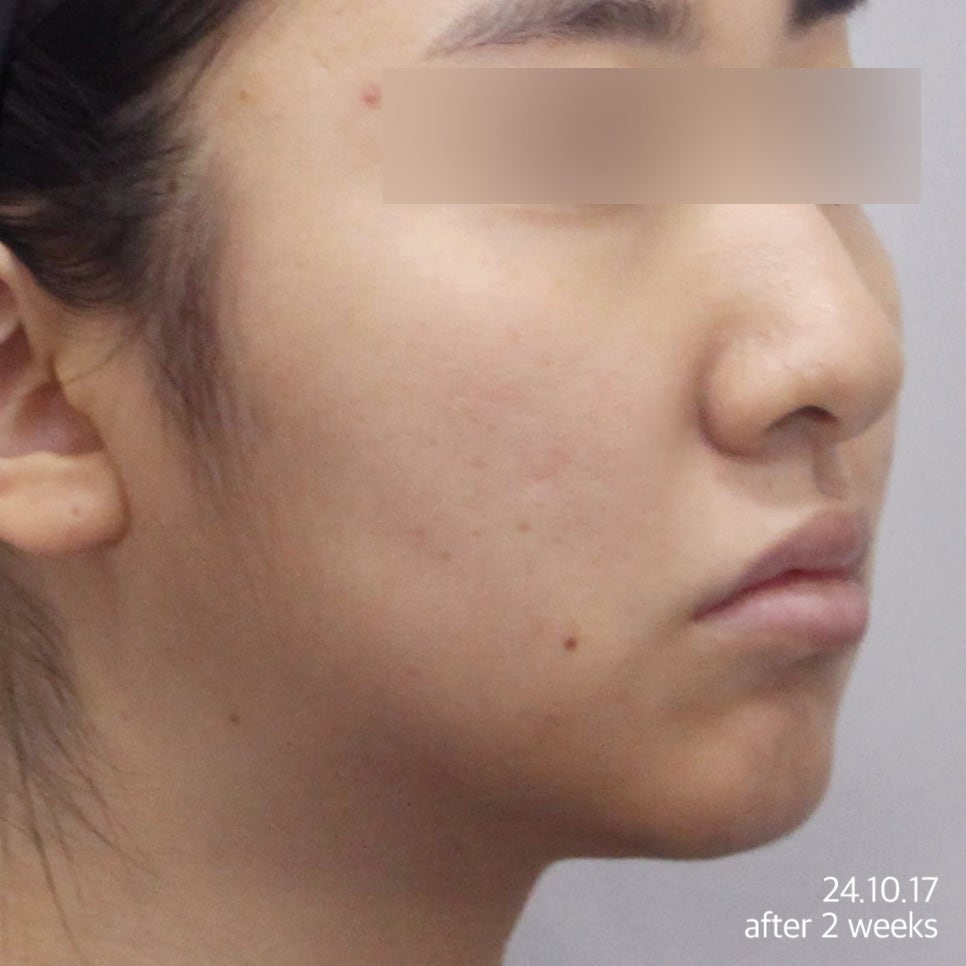 튠라이너 & 튠페이스 시술, 어떤 효과 있을까? 리프팅 + 탄력 관련 이미지 8
