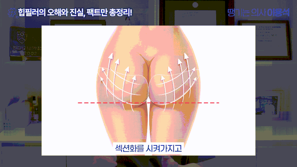 골반필러 흘러내릴까요? 유지기간부터 부작용, 힙딥까지 자주 묻는 질문 총정리 관련 이미지 6
