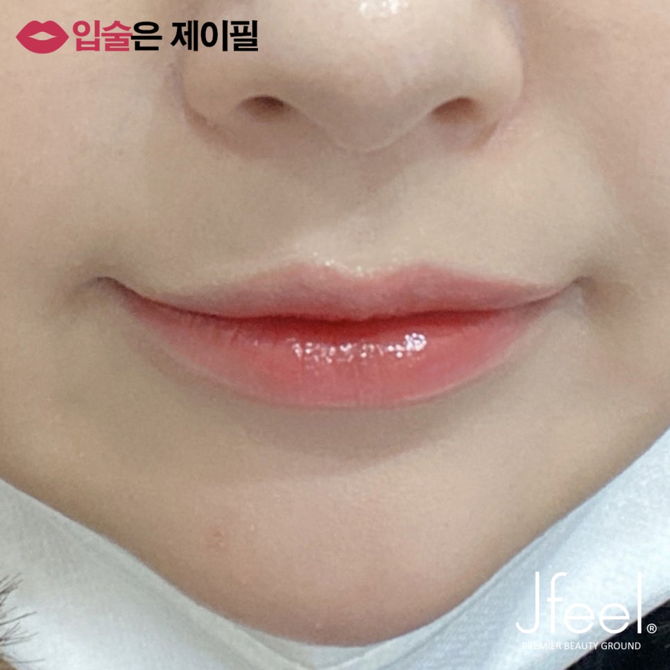 입술필러 맞고 조심해야 할 점, 주의사항, 통증, 붓기 관련 이미지 8
