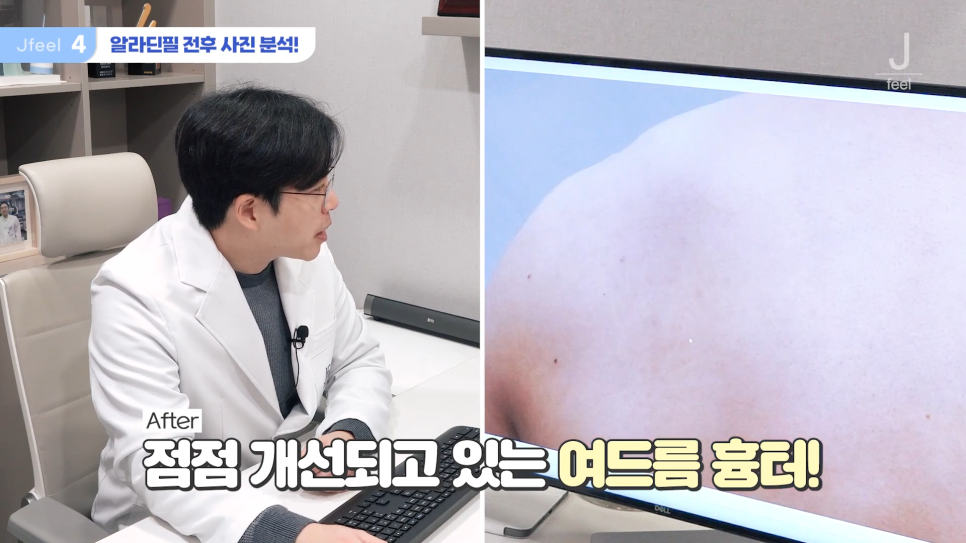 등여드름필링으로 연예인 등 만들기 관련 이미지 16