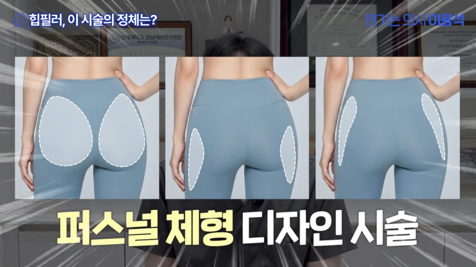 Why Butt-Only Workouts Aren't Enough｜When Hip Fillers Are Needed for Hip Dips image 27