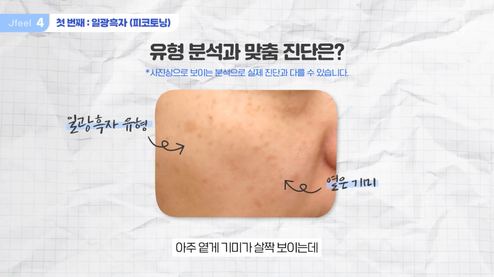 기미 주근깨 잡티에 이 시술만은 NO! 시술 전 필독 관련 이미지 8