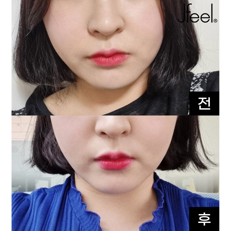 이중턱, 심부볼 윤곽주사 스테로이드 없는 후아유 후기 관련 이미지 2