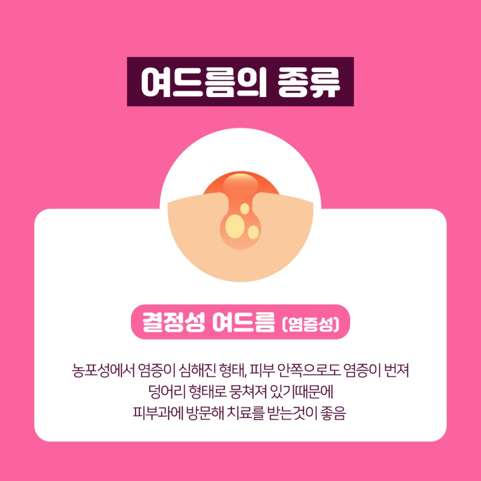 화농성여드름에도 탁월한 여드름레이저 관련 이미지 8