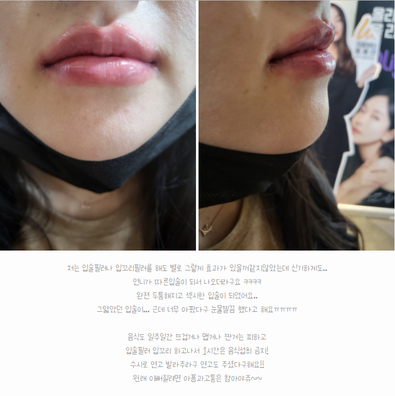 홍대입술필러 한예슬 벨로테로필러 후기 관련 이미지 3