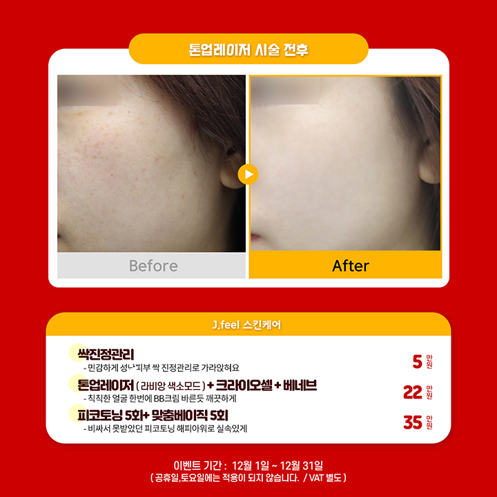 예뻐지는 홍대피부과 타임이벤트 12월의 해피아워 관련 이미지 2