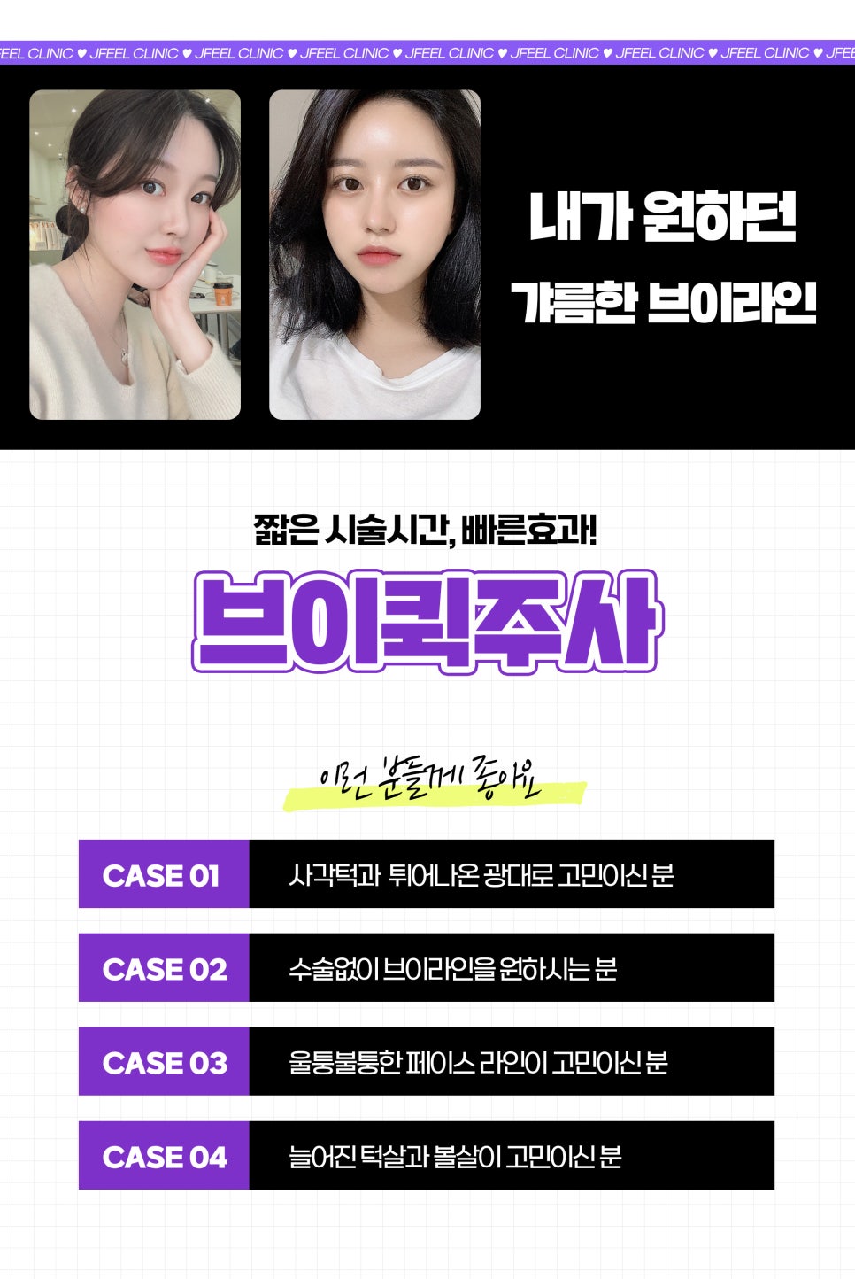 사각턱주사 얼굴 라인 개선을 원한다면 관련 이미지 7