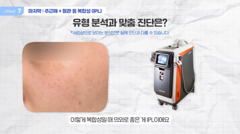기미 주근깨 잡티에 이 시술만은 NO! 시술 전 필독 관련 이미지 13