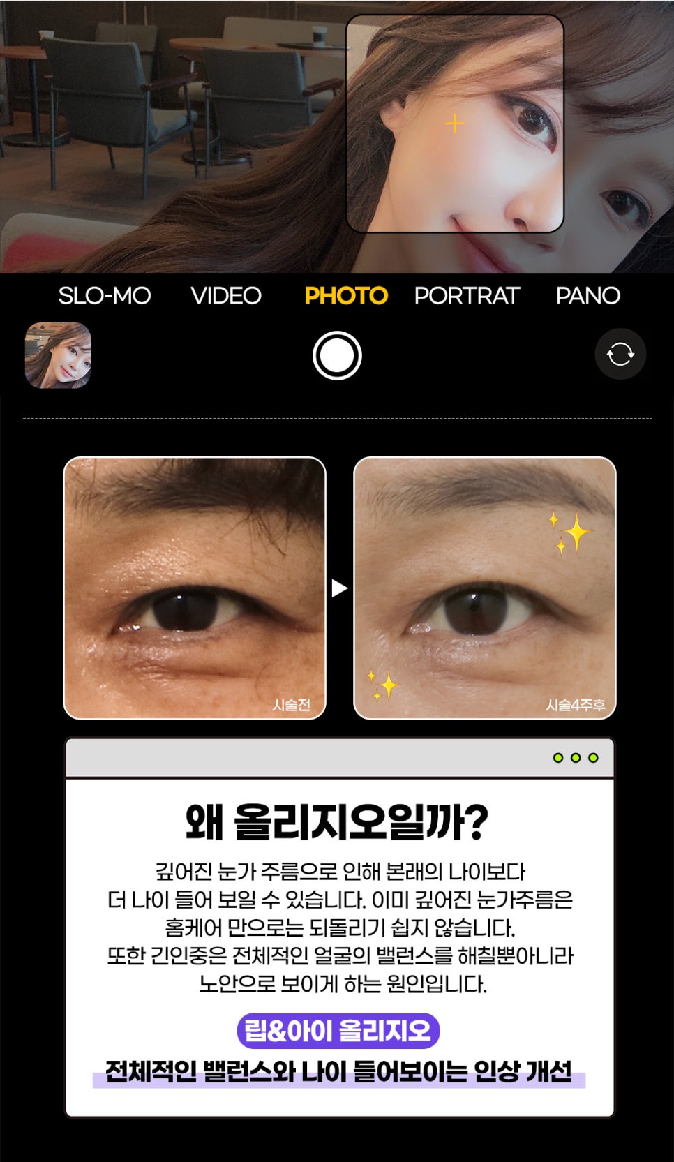 눈밑주름레이저 아이올리지오는 제이필의원에서 관련 이미지 2