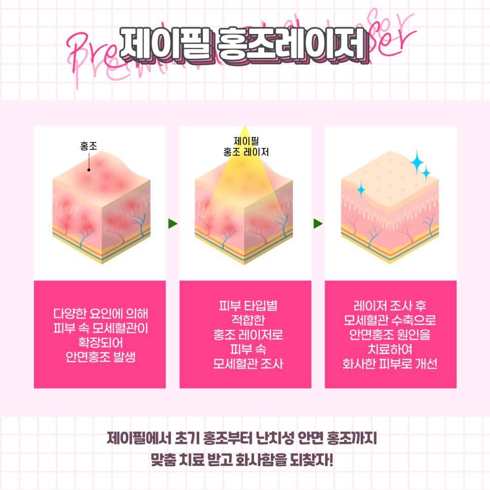 촌티나는 붉은 얼굴, 홍조레이저로 말끔하게! 관련 이미지 4