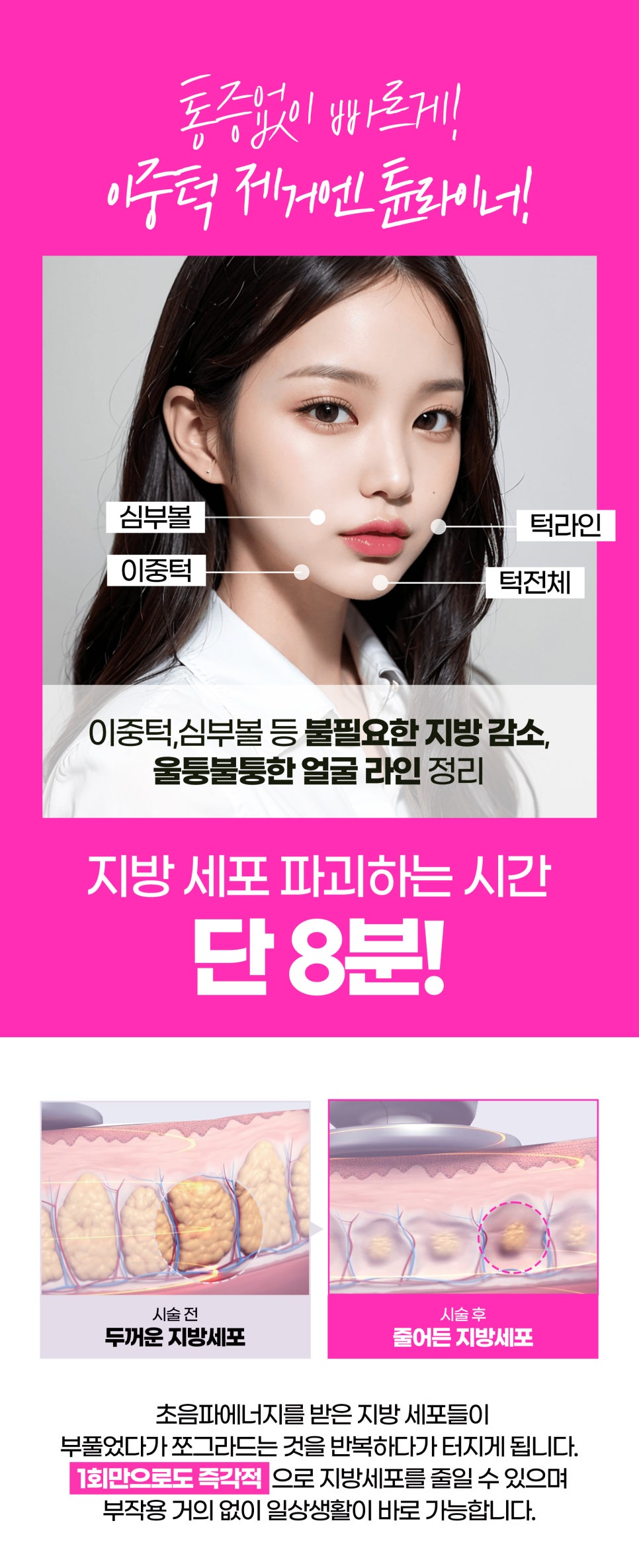 브이라인리프팅, 튠라이너 브이슈링크로 날렵하게 관련 이미지 4