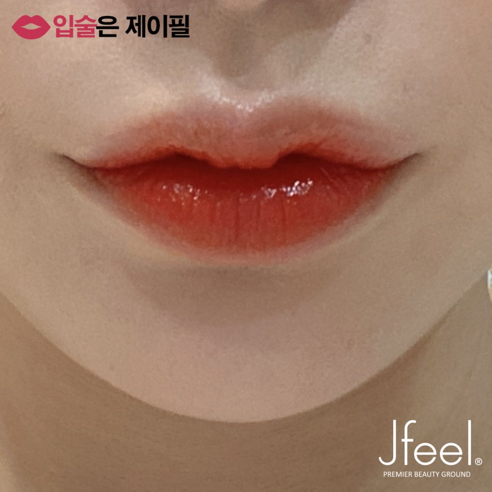 입술필러 유지기간 얼마나 되나요? 관련 이미지 1