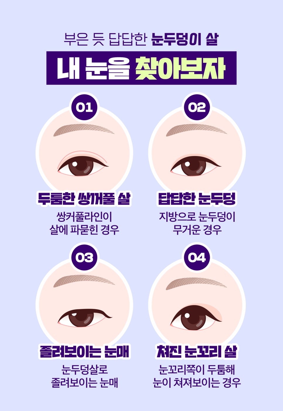 비절개 비수술로 눈두덩지방제거&눈매교정! 관련 이미지 4