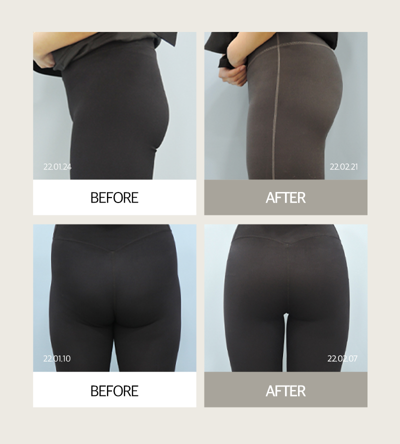 Solving Lower-Body Line Concerns, Creating Apple Hips with J-FILL Hip Filler and Butt Filler image 14