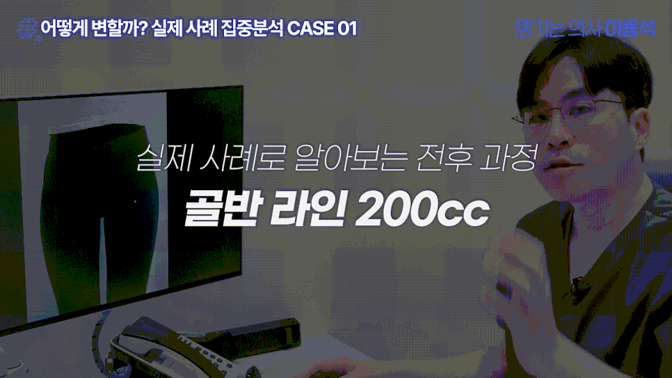 힙필러 전 꼭 알아야 할 사실|힙딥은 단순히 볼륨보다 구조가 중요합니다 관련 이미지 17
