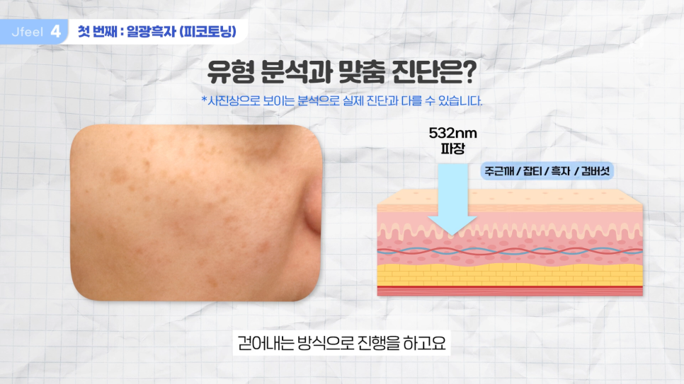 기미 주근깨 잡티에 이 시술만은 NO! 시술 전 필독 관련 이미지 9