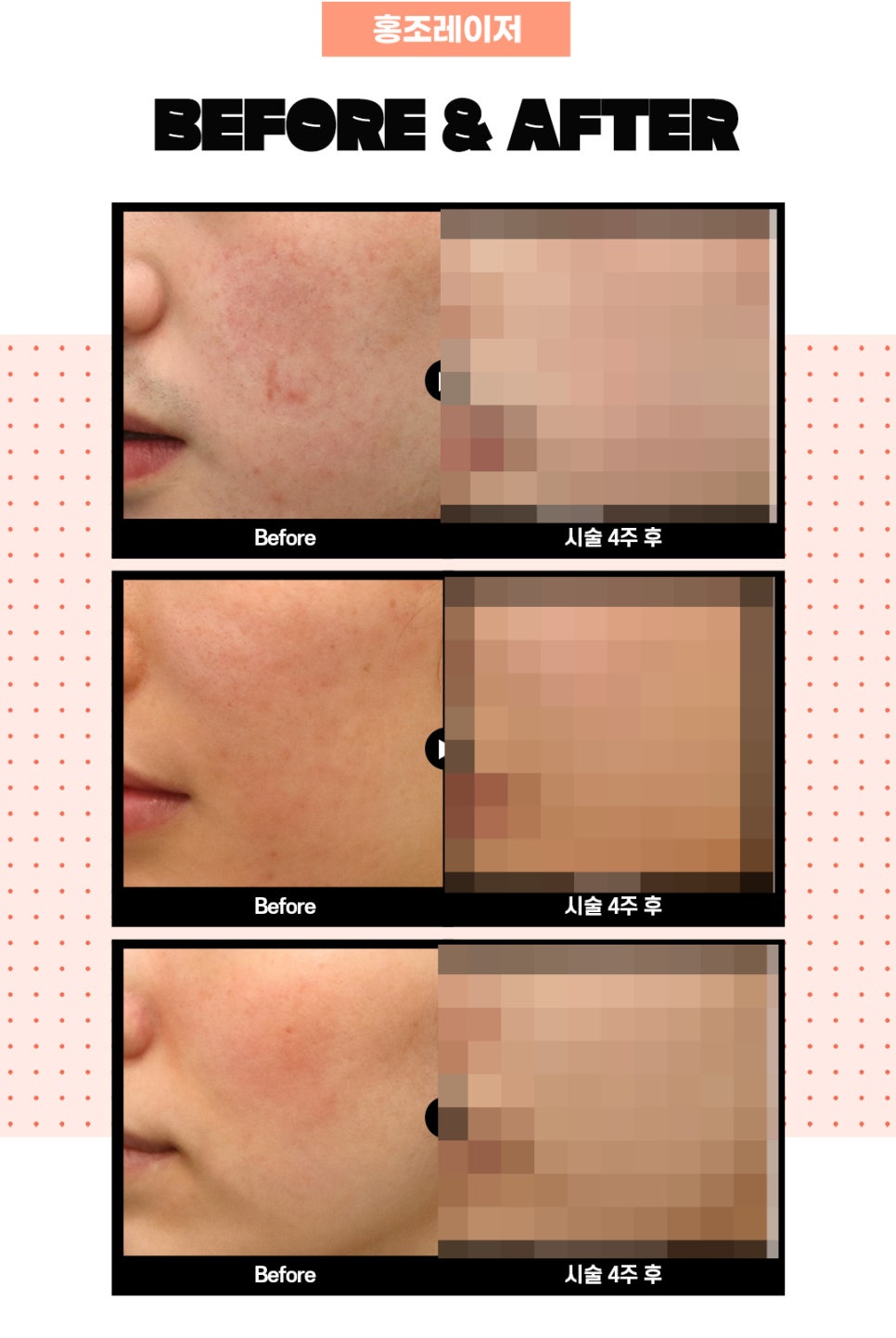 홍조피부과에서 발그레한 홍조 없애고 만족 관련 이미지 7