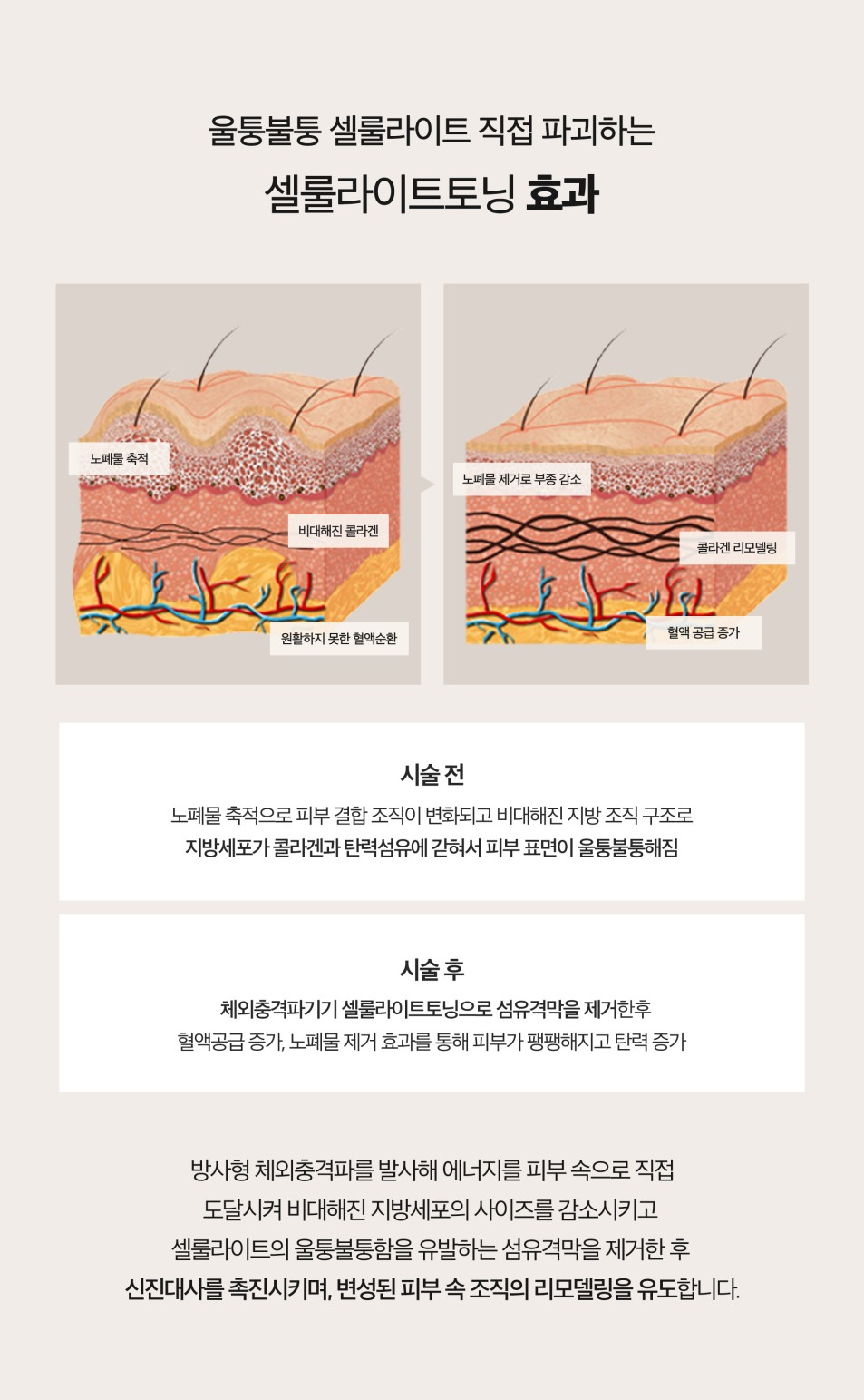 셀룰라이트토닝으로 피부 탄력 증가 관련 이미지 3