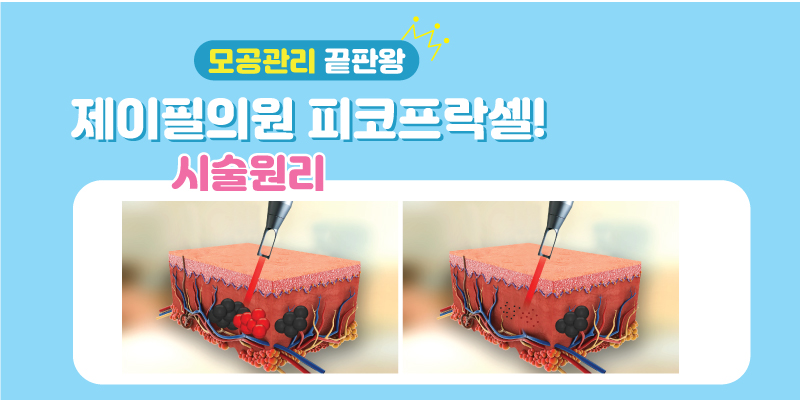 [홍대피부과] 모공관리 끝판왕 제이필의원의 피코프락셀! 관련 이미지 3