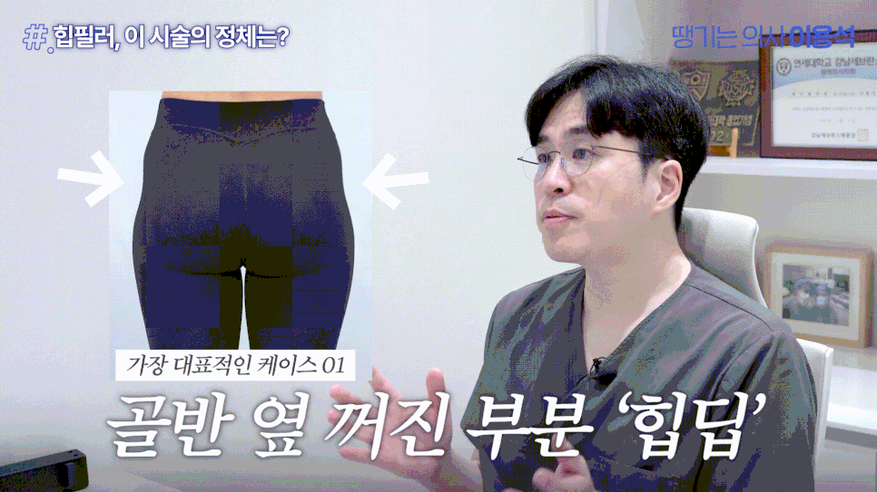 힙필러 전 꼭 알아야 할 사실|힙딥은 단순히 볼륨보다 구조가 중요합니다 관련 이미지 7