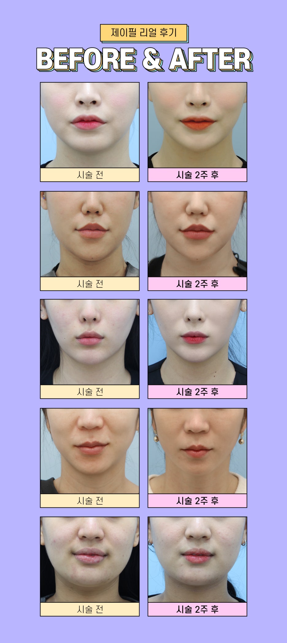 윤곽슈링크 슈링크+파워윤곽주사로 갸름하고 날렵하게 턱선관리 가능! 관련 이미지 7
