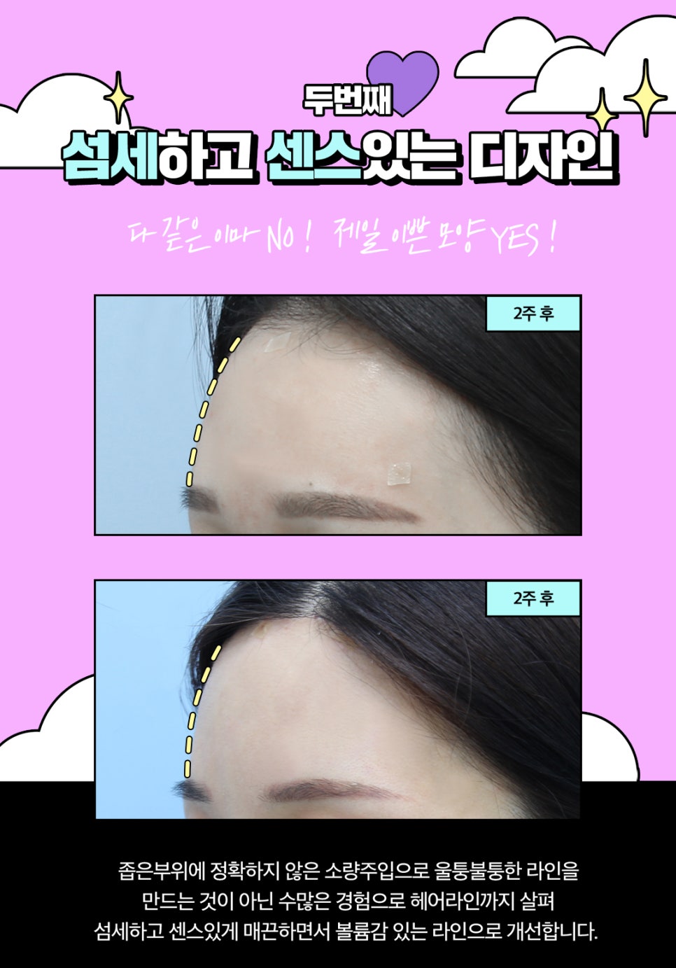 얼굴 동안시술로 자연스럽게 예뻐지고 싶다면? 관련 이미지 8