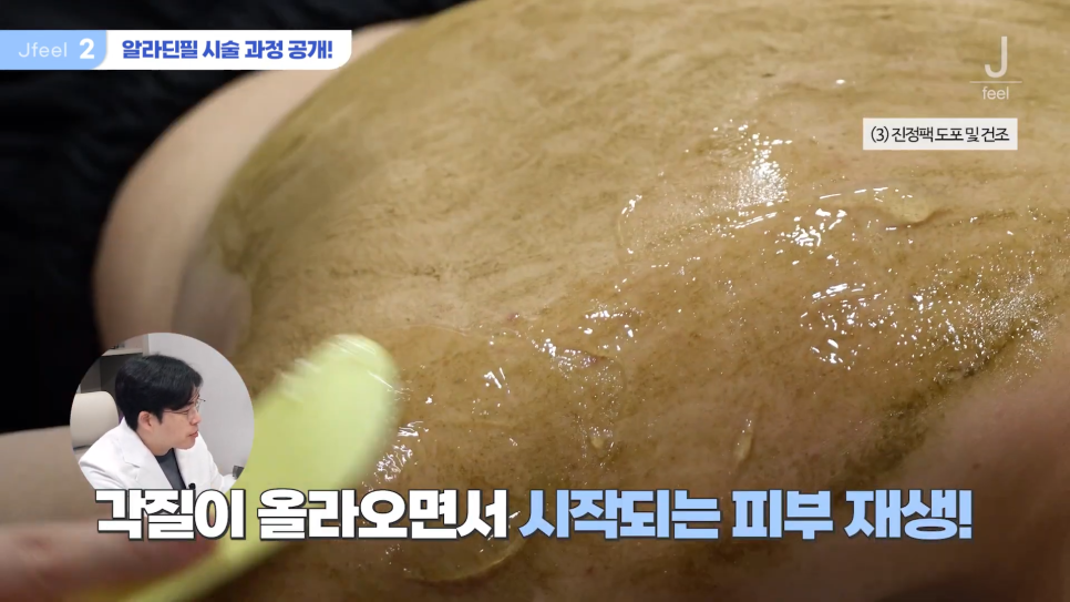 등여드름필링으로 연예인 등 만들기 관련 이미지 7