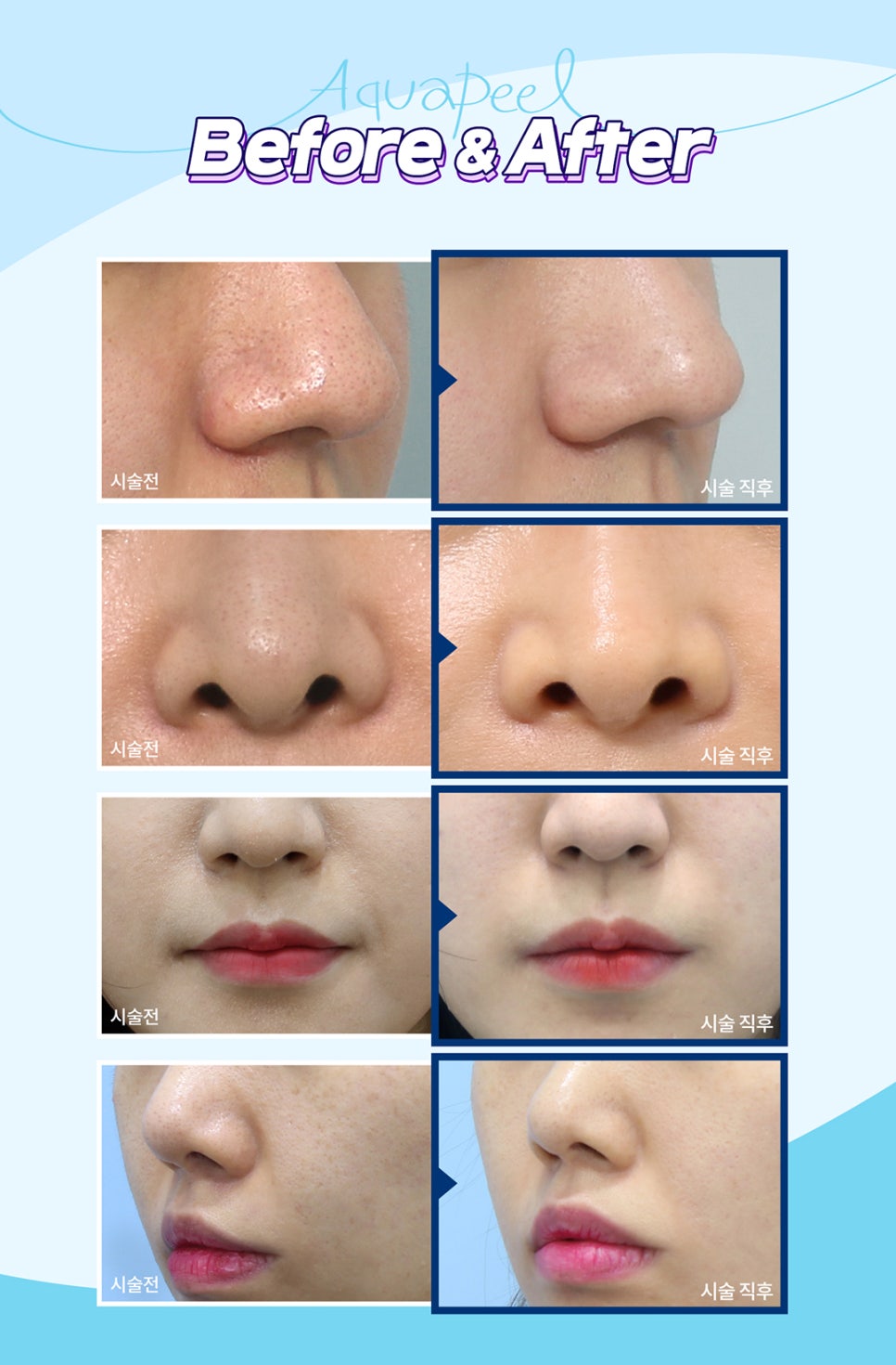 블랙헤드, 모공관리엔 촉촉한 아쿠아필로 효과보세요 관련 이미지 7