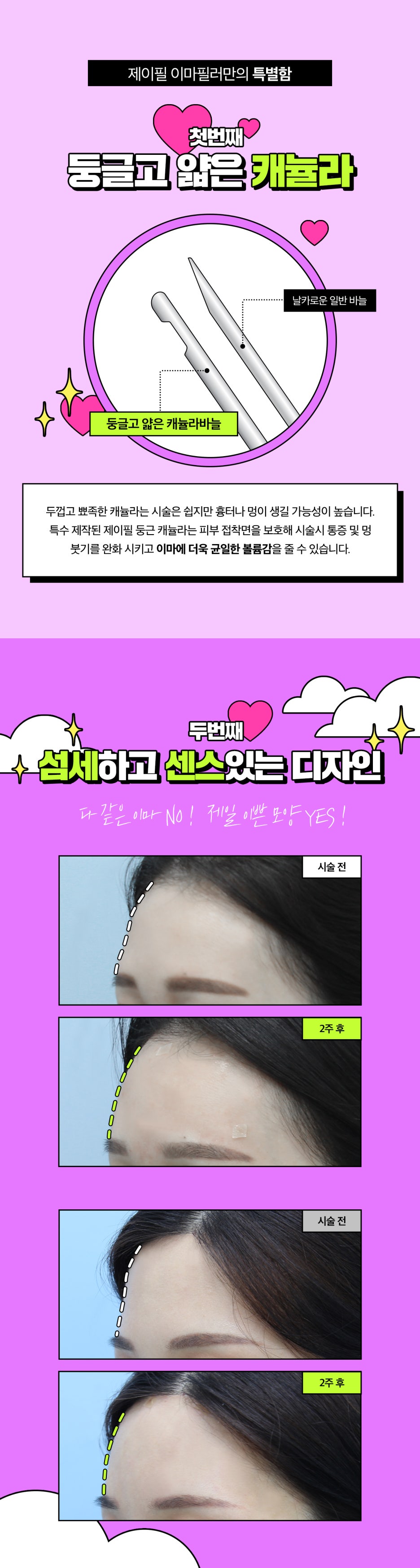 이마필러 잘하는 곳 찾고 있었다면? 홍대 볼륨팡 이마필러 관련 이미지 4