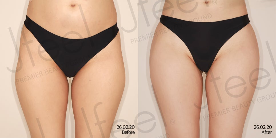A Sunken Hip Dip Line: Hip Filler vs. Fat Grafting, Which Is Better? image 8