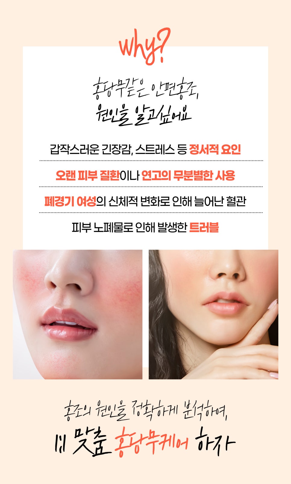 홍조없애기, 홍조레이저와 크라이오셀 관련 이미지 2
