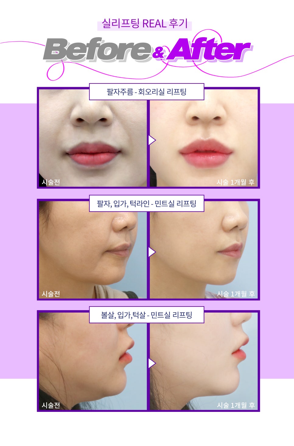 얼굴 실리프팅 멍,비용,후기 관리법 까지 제이필에서 관련 이미지 7