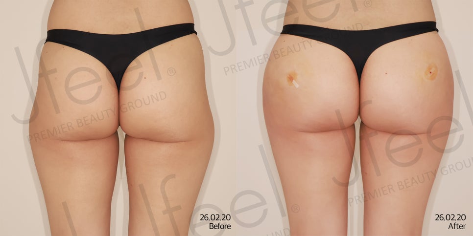 A Sunken Hip Dip Line: Hip Filler vs. Fat Grafting, Which Is Better? image 9