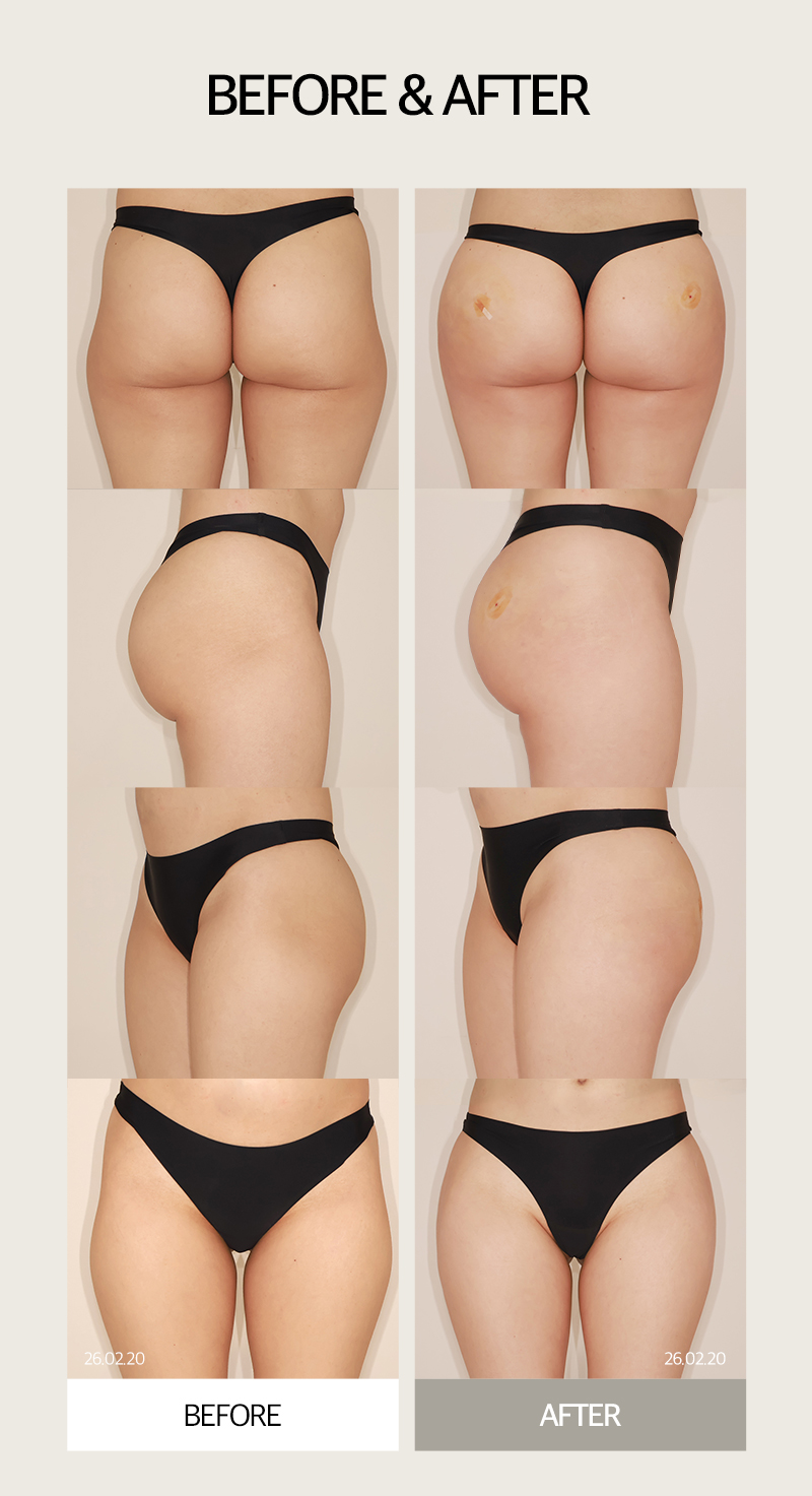 Solving Lower-Body Line Concerns, Creating Apple Hips with J-FILL Hip Filler and Butt Filler image 12