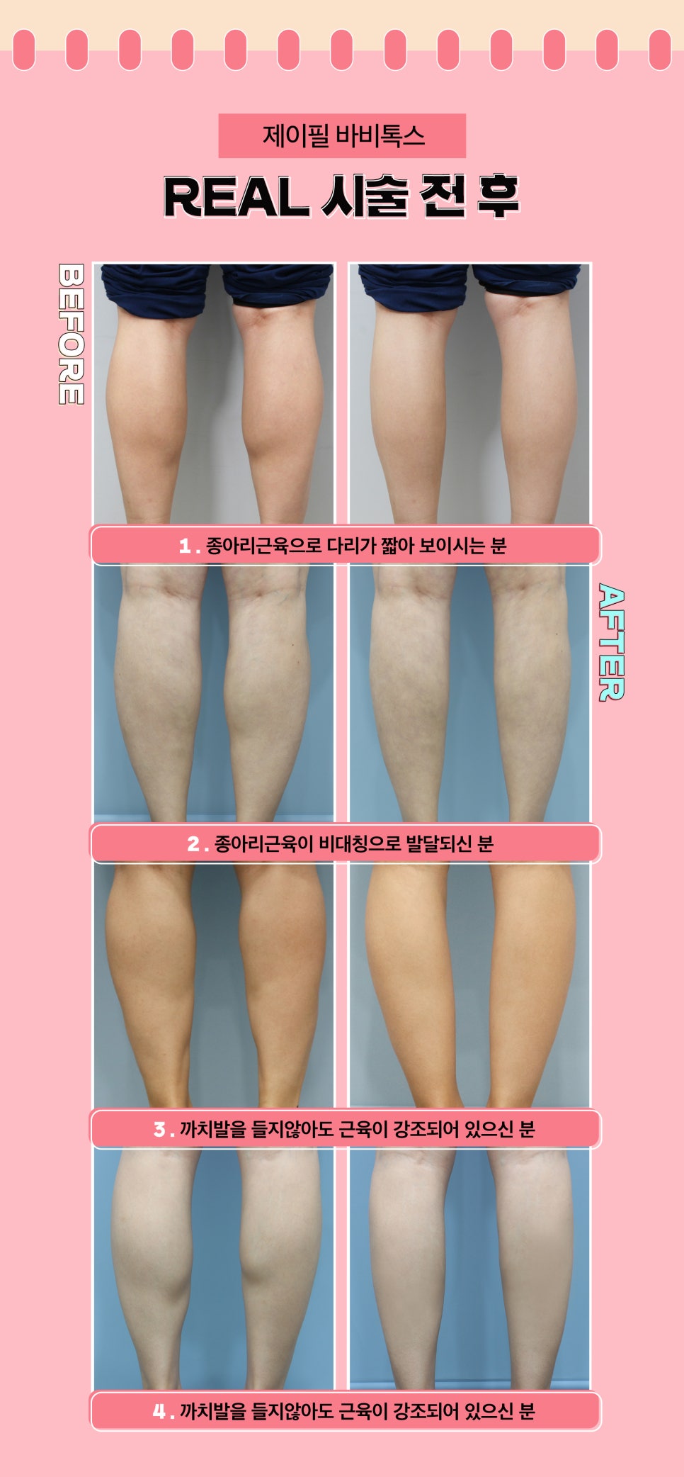 종아리라인, 바디톡스로 매끈한 인형 다리 만들기 관련 이미지 7