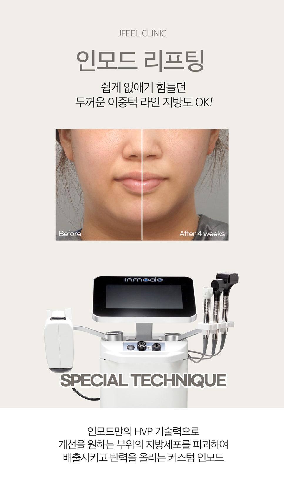 V라인만들기는 확실하게 튠인모드로 관련 이미지 6