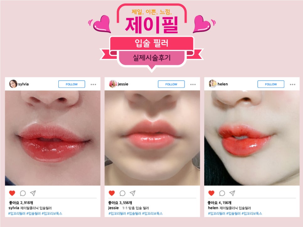 [홍대피부과] 얼굴 매력을 한껏 더 돋보이게 하는 입술필러 관련 이미지 4